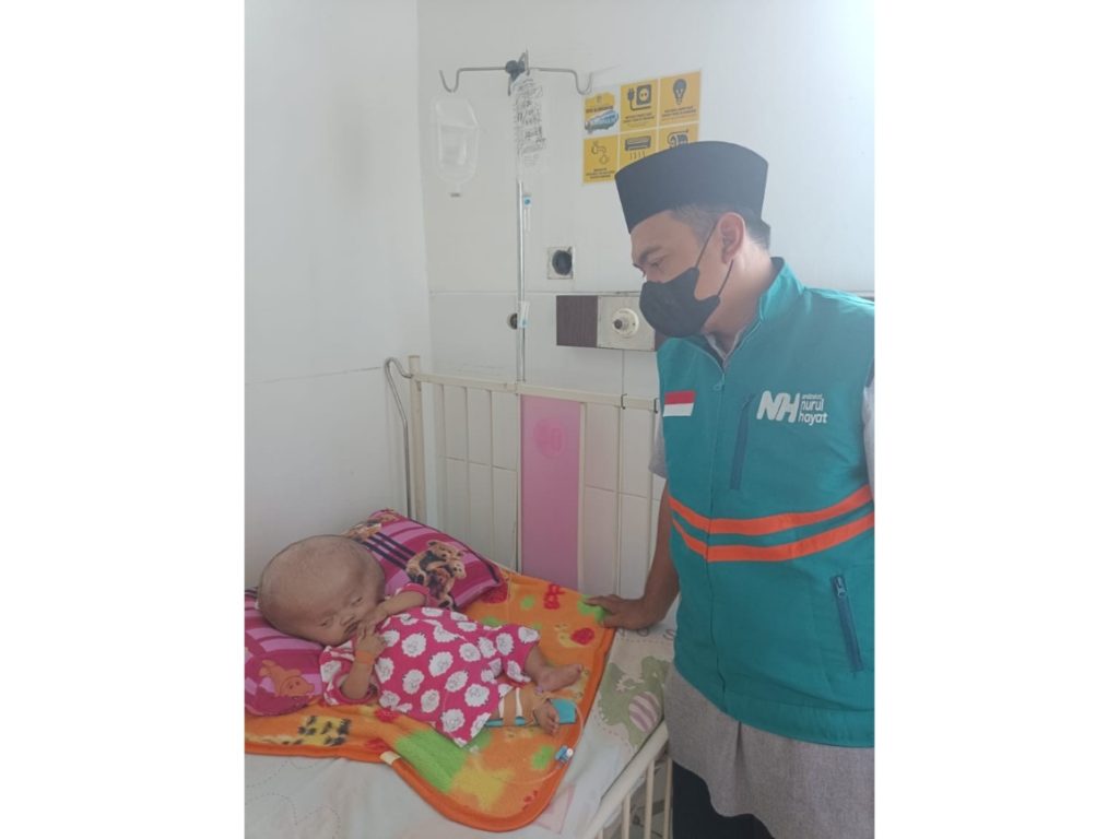 Bantu Kebutuhan Putri, Adik Yatim yang Sakit Hidrosefalus